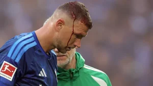 Zabrinjavajuće scene u Njemačkoj: Edin Džeko krvave glave napustio teren!